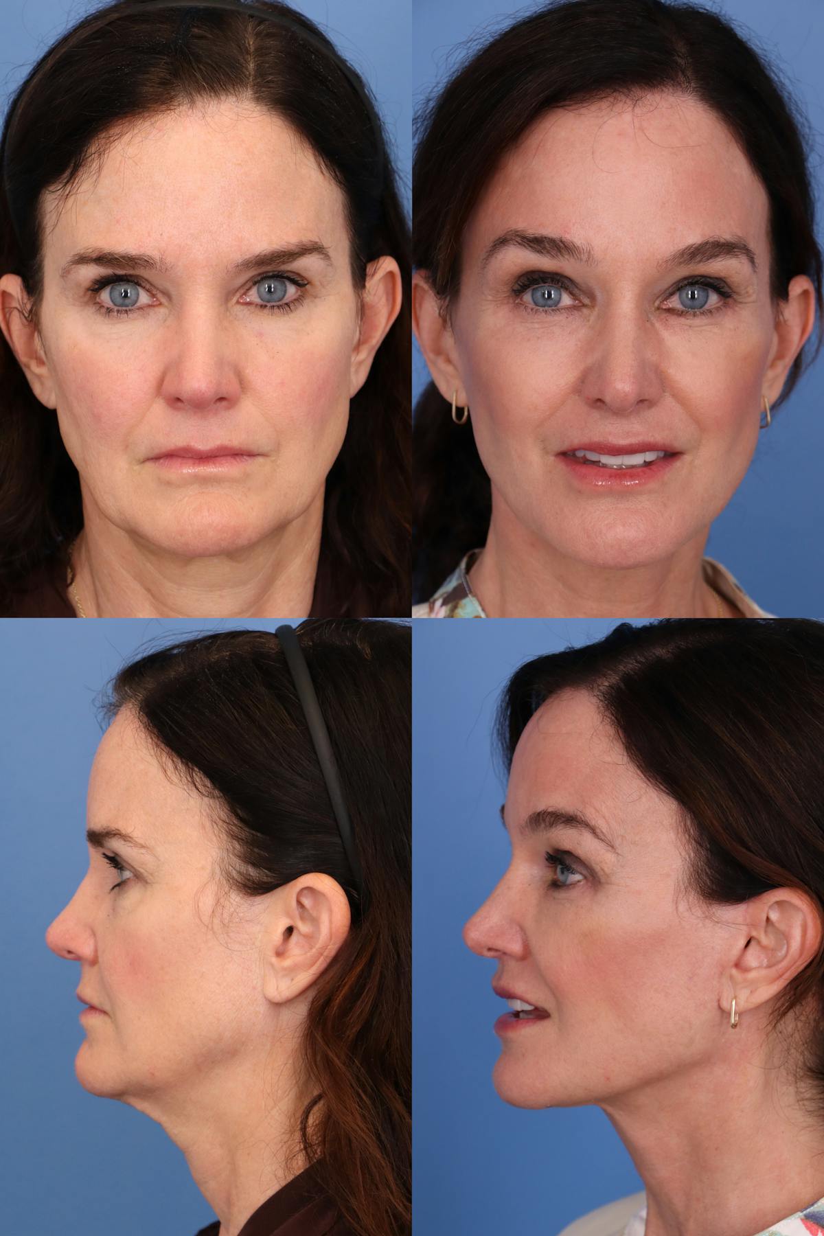 Facelift  Before & After Gallery - Patient bdrPXaQlQfCoH7zZKEy2nQ - Image 1