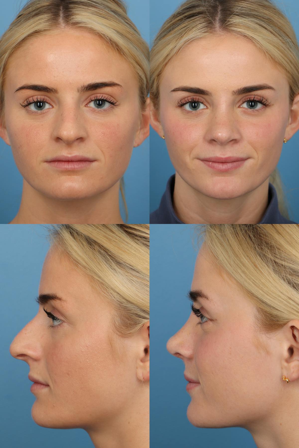 Dorsal Hump Before & After Gallery - Patient UFaMHcaZRqimNF-amKWEtg - Image 1