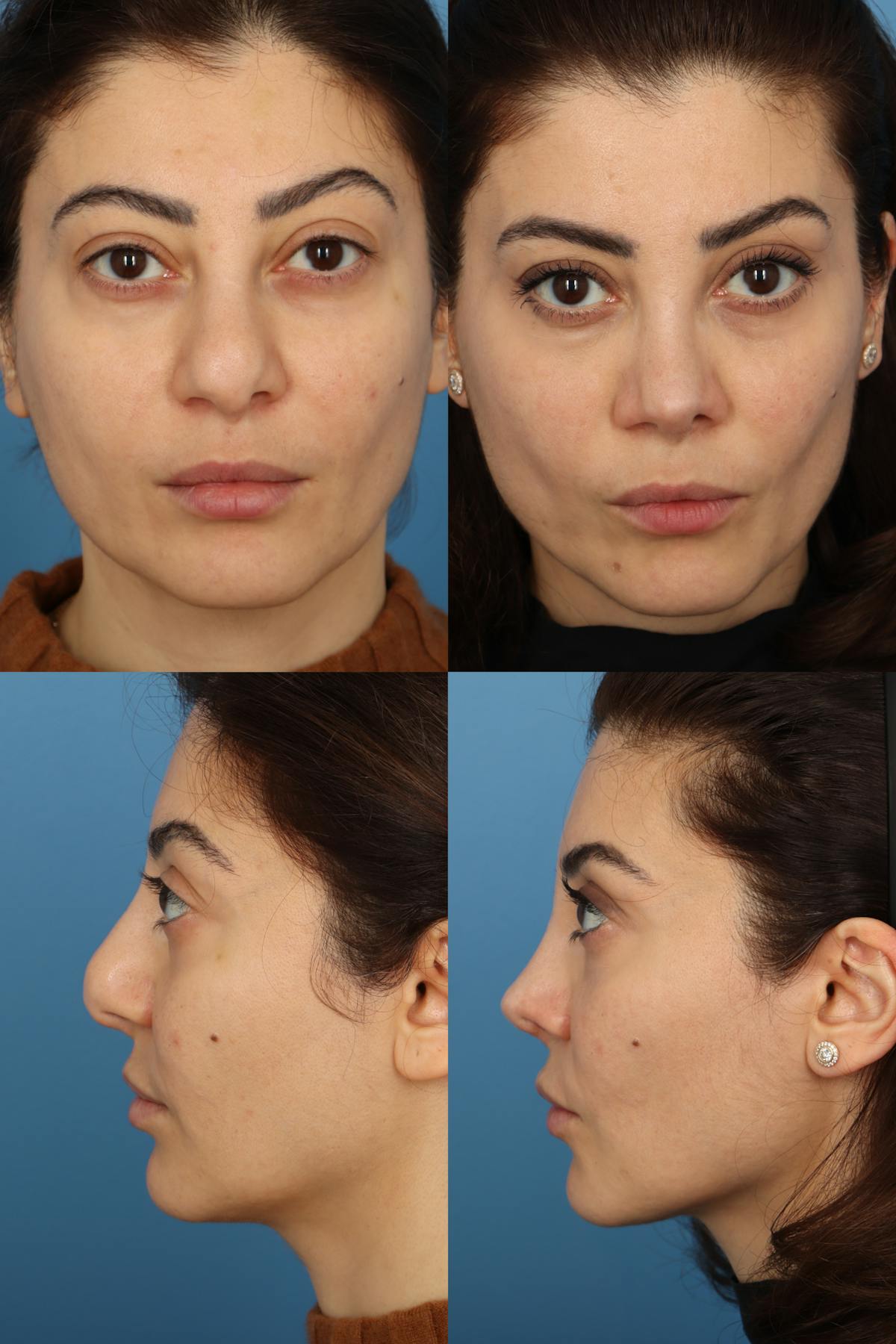 Bulbous Tip Before & After Gallery - Patient KaQJIMNuRN-NRJ8MR6UN3w - Image 1