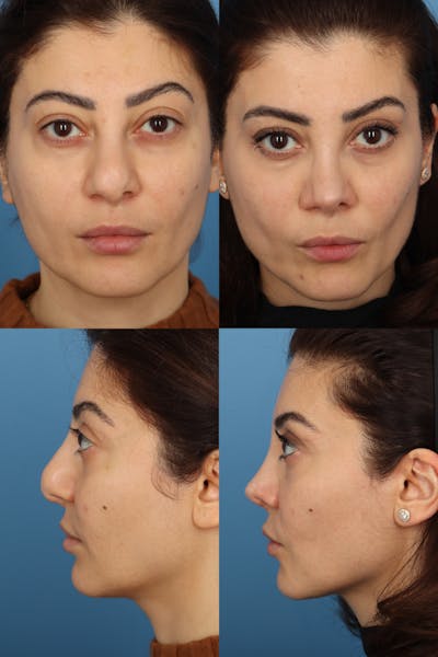 Bulbous Tip Before & After Gallery - Patient KaQJIMNuRN-NRJ8MR6UN3w - Image 1