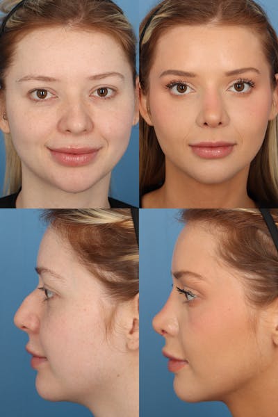 Dorsal Hump Before & After Gallery - Patient TrIfps1aSE-97loWxTXWVA - Image 1