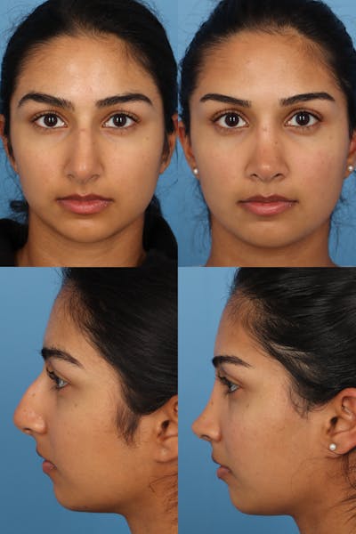 Dorsal Hump Before & After Gallery - Patient RM5-gNFcT6eylKEs933SWA - Image 1
