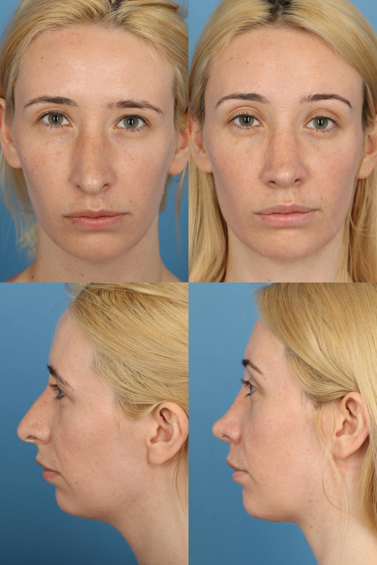 Prominent Nostril / Hanging Columella Before & After Gallery - Patient 279464 - Image 1