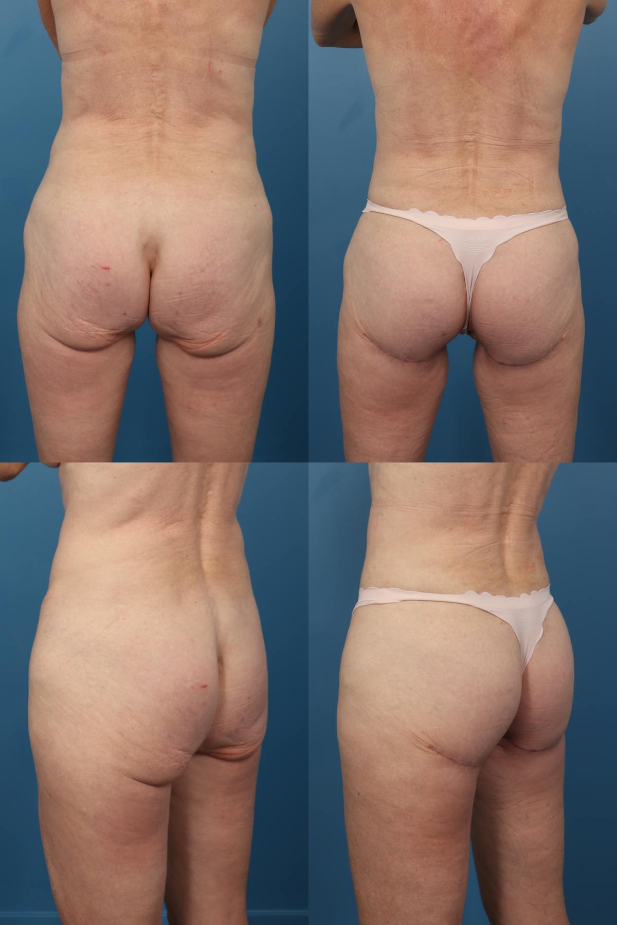 Thong Lift / Infragluteal Thigh Lift Before & After Gallery - Patient 465164 - Image 1