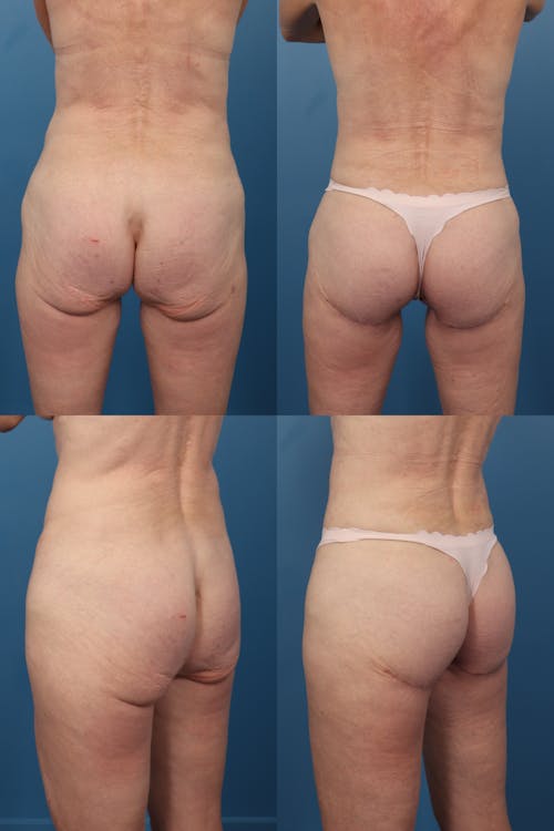 Patient 1 Before - Thong Lift / Infragluteal Thigh Lift
