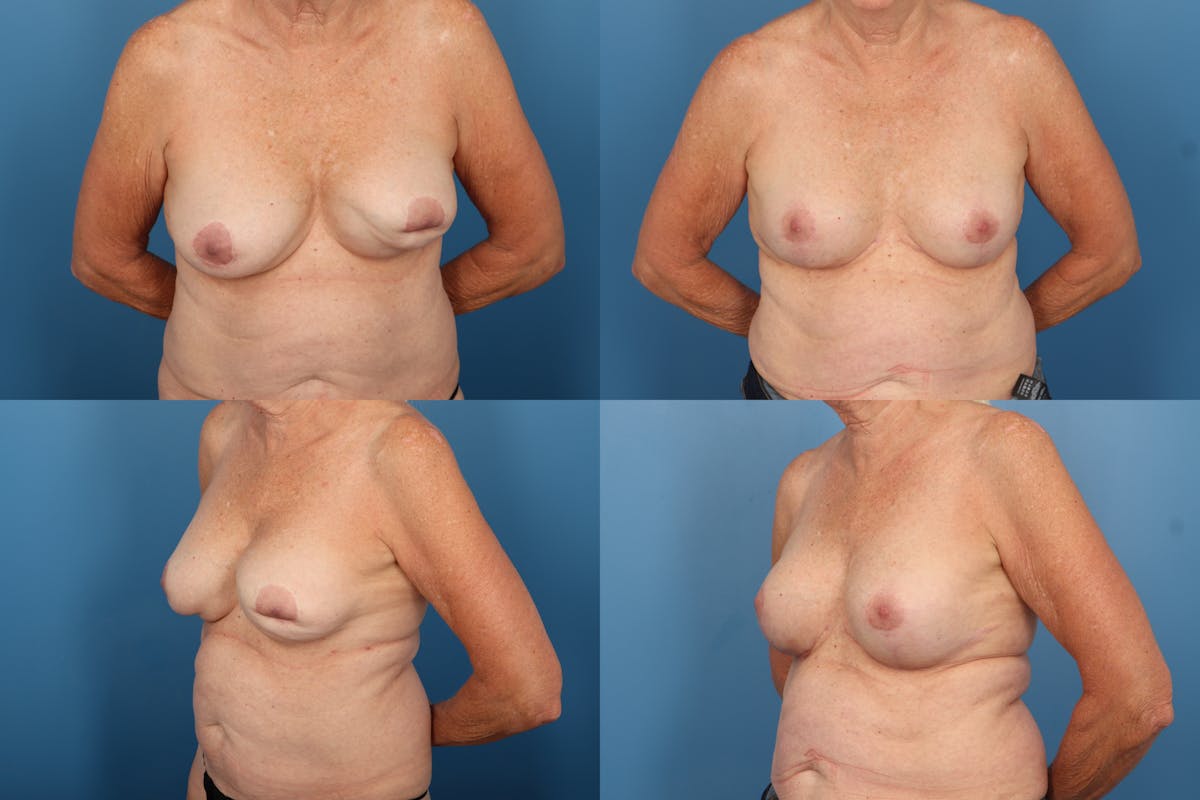 Reductive Augmentation of the Breast Before & After Gallery - Patient 120096 - Image 1