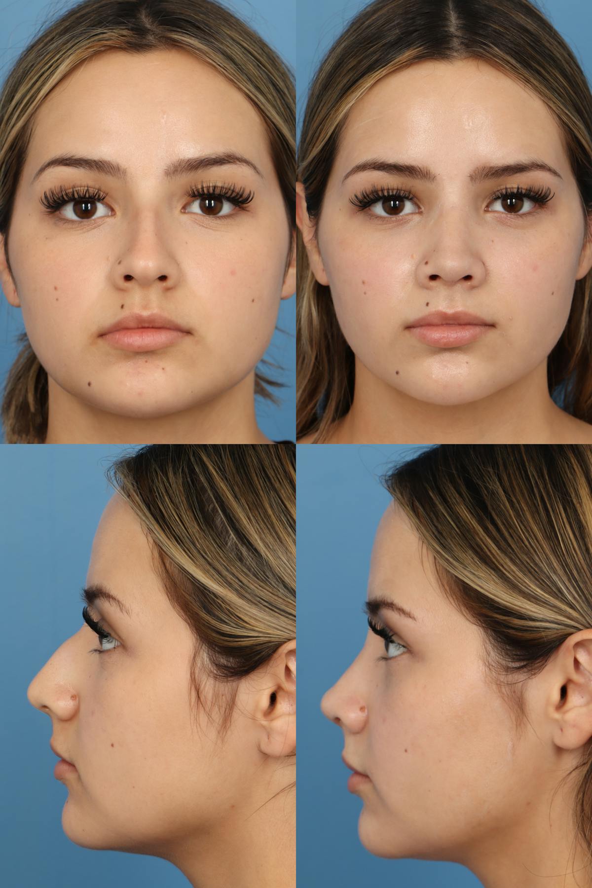 Dorsal Hump Before & After Gallery - Patient 178904 - Image 1