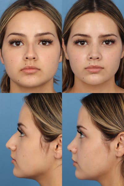 Dorsal Hump Before & After Gallery - Patient aNymc2dFRYK5DC4s7GyNLA - Image 1