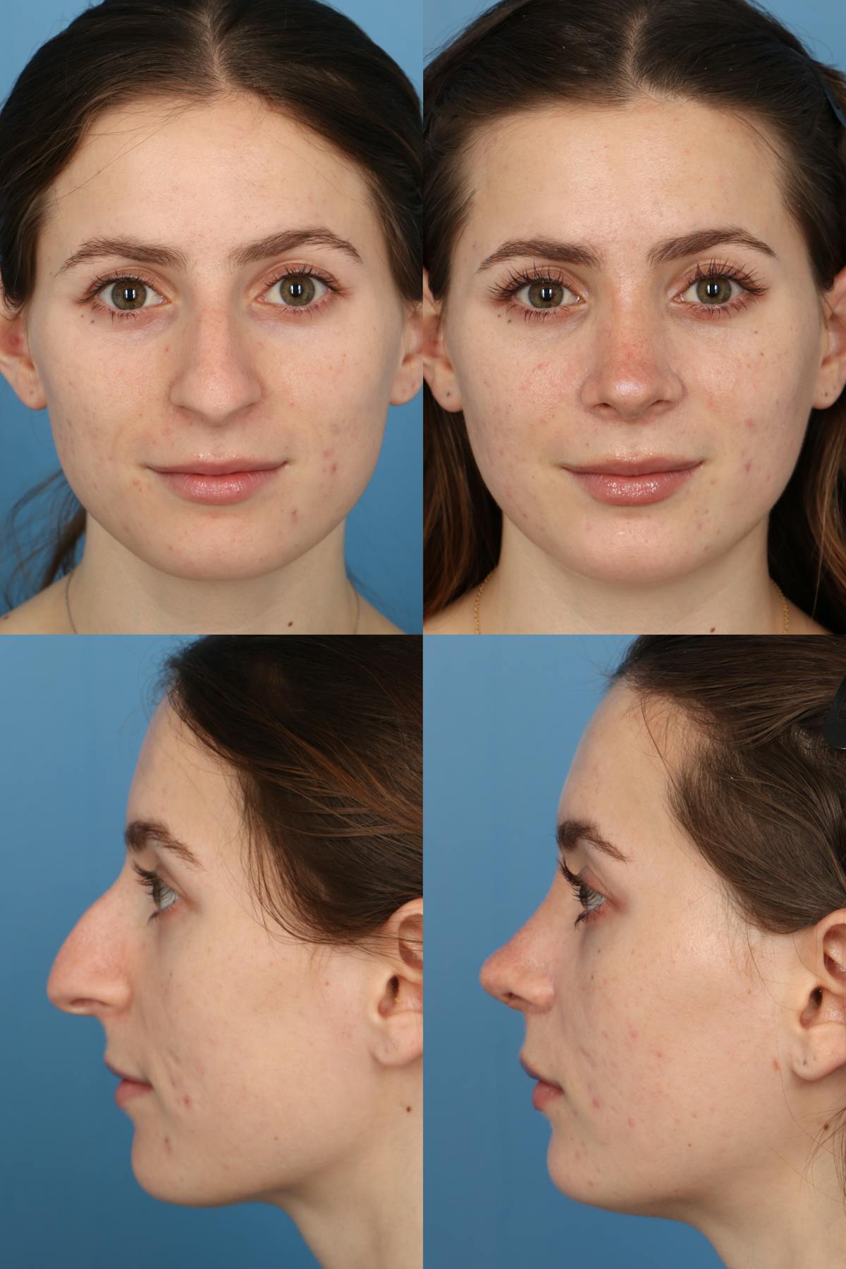 Dorsal Hump Before & After Gallery - Patient 888396 - Image 1