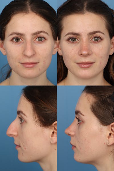 Dorsal Hump Before & After Gallery - Patient AOa0qLOpTCO-ZFdmTVJkdg - Image 1