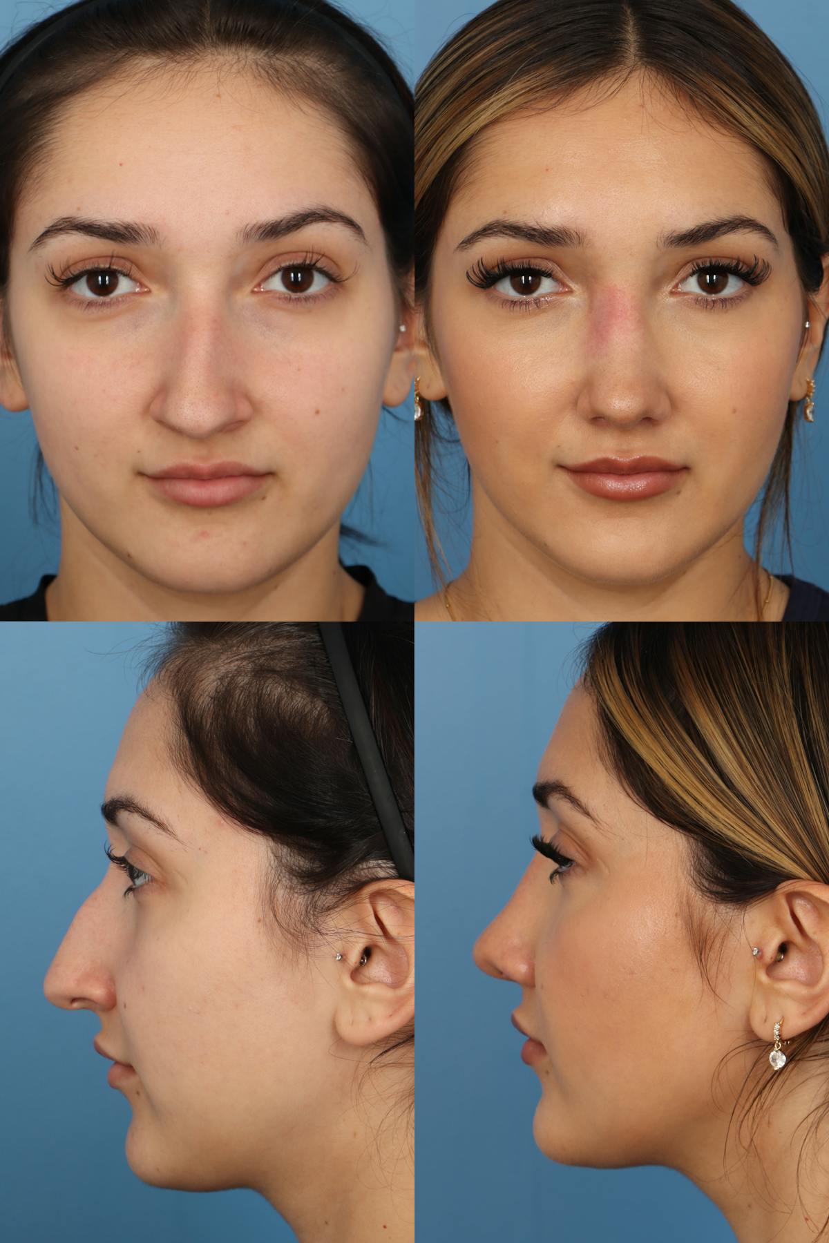 Dorsal Hump Before & After Gallery - Patient 324176 - Image 1