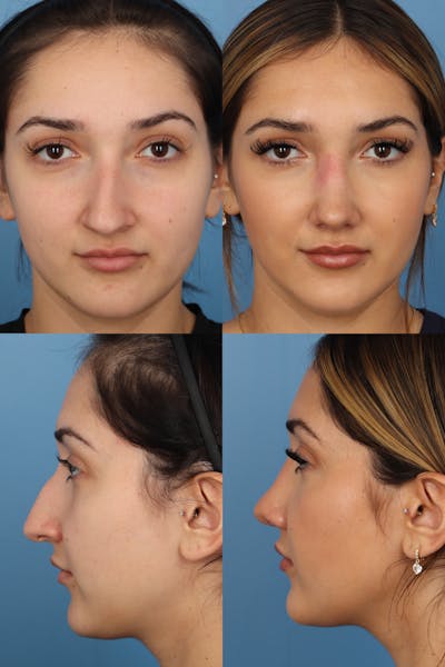 Dorsal Hump Before & After Gallery - Patient GEELxHLrQkSFx_Oqa4PONg - Image 1