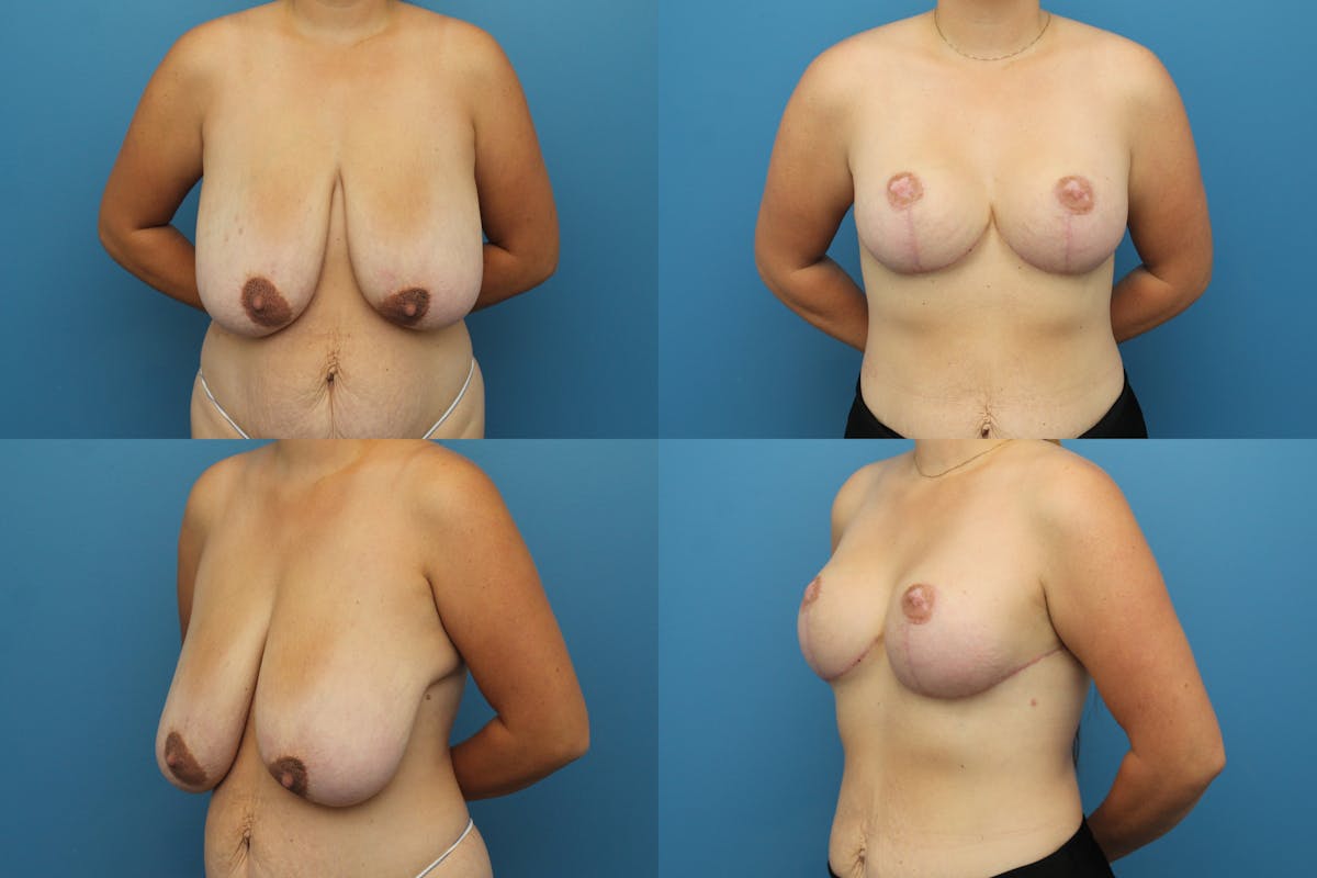 Reverse Tummy Tuck Before & After Gallery - Patient 228762 - Image 1