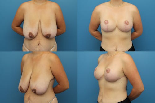 Patient 4 Before - Reverse Tummy Tuck