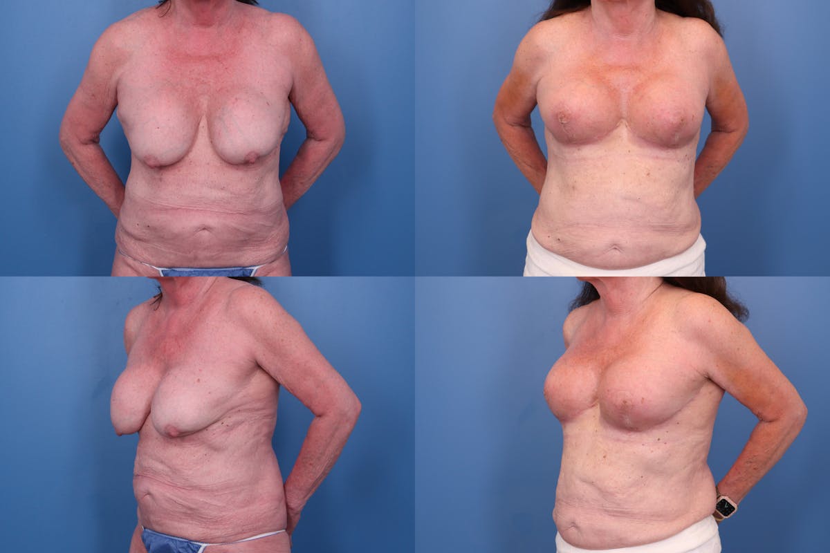 Reverse Tummy Tuck Before & After Gallery - Patient 376649 - Image 1