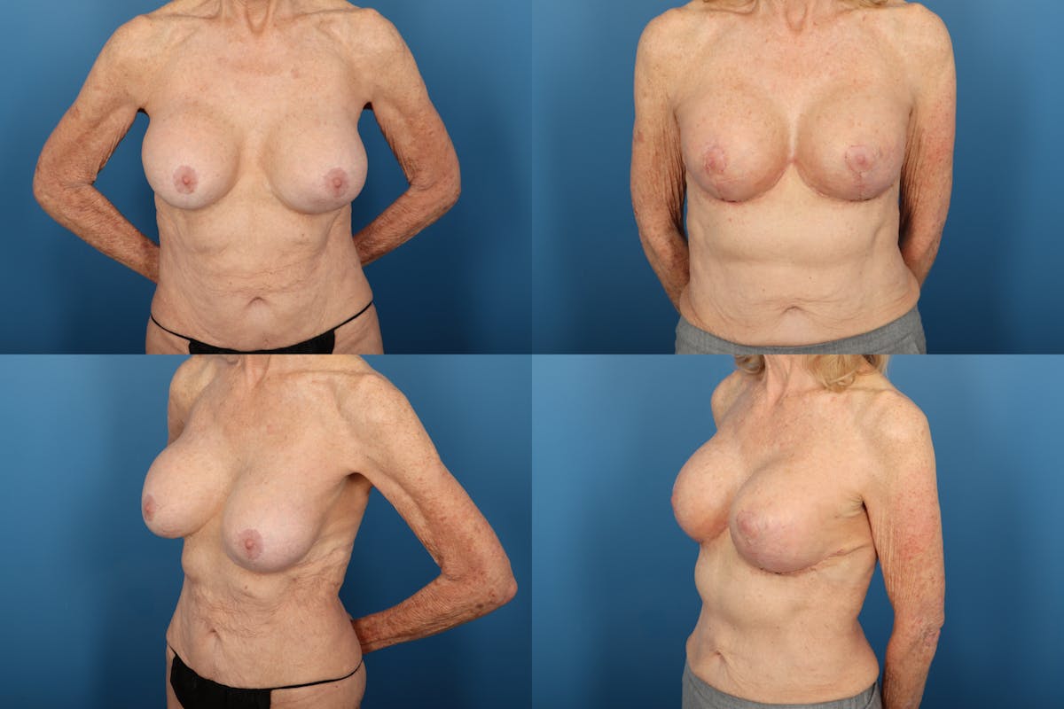 Reverse Tummy Tuck Before & After Gallery - Patient 203167 - Image 1