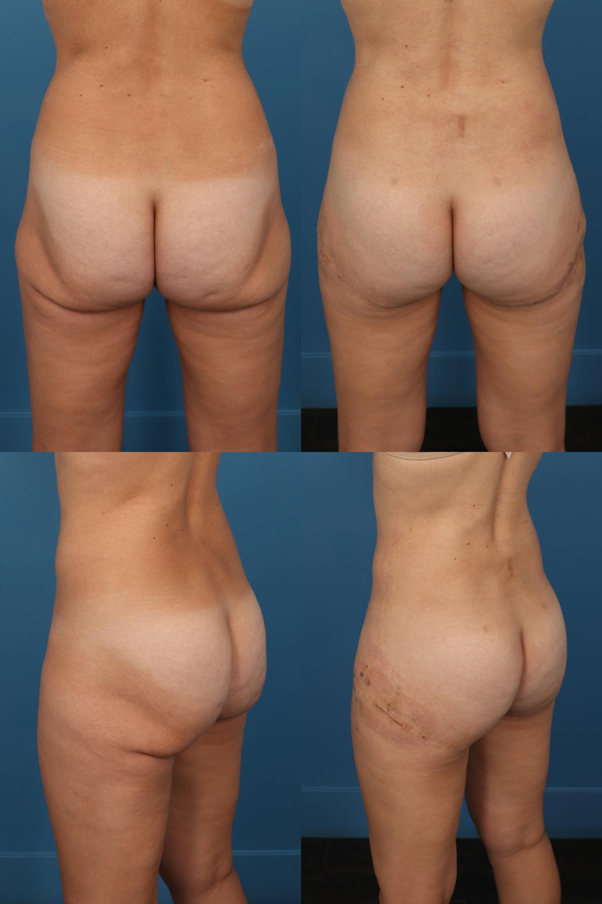 Thong Lift / Infragluteal Thigh Lift Before & After Gallery - Patient 783475 - Image 1