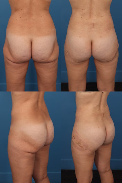 Patient 1 Before - Thong Lift / Infragluteal Thigh Lift
