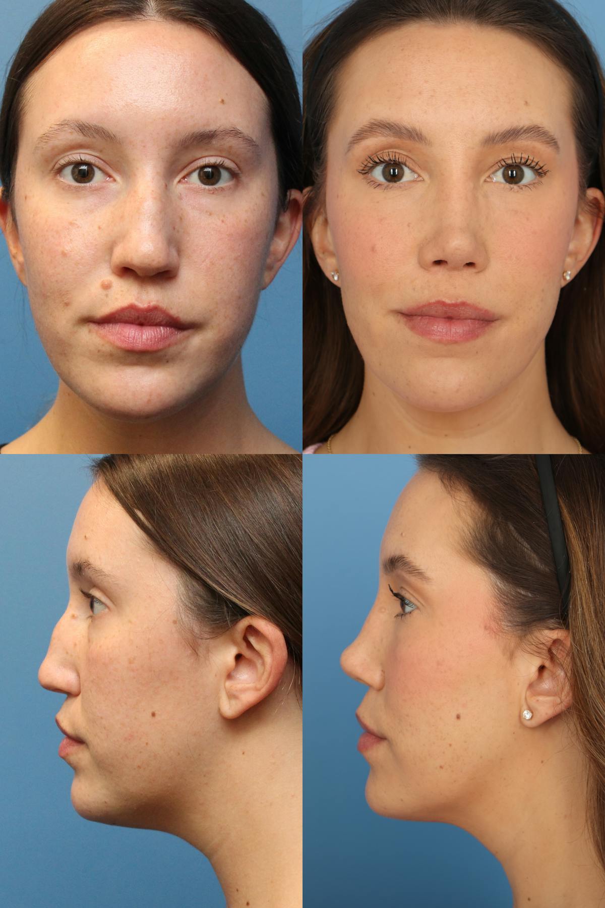 Dorsal Hump Before & After Gallery - Patient 666677 - Image 1