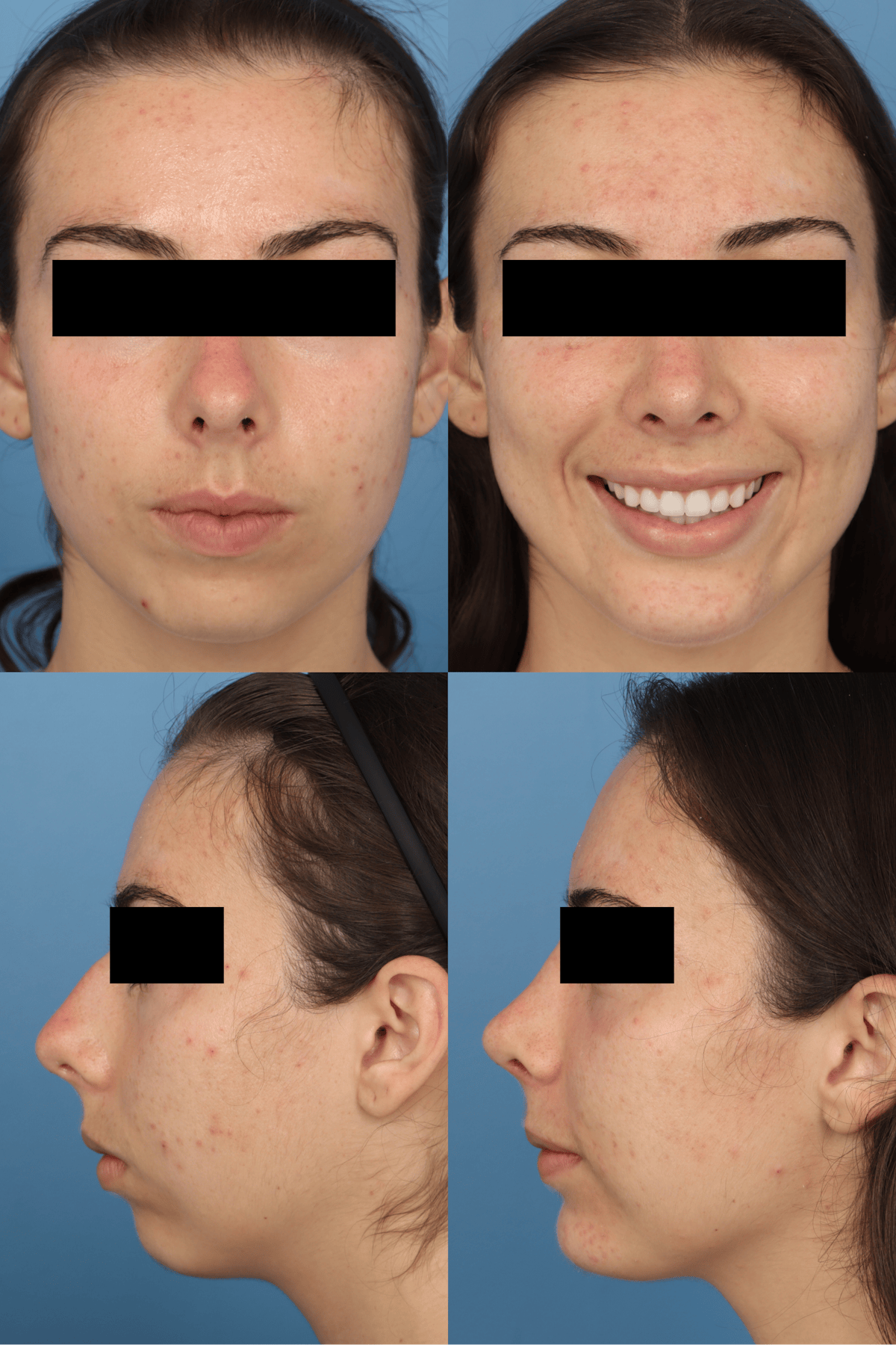 Dorsal Hump Before & After Gallery - Patient 226594 - Image 1