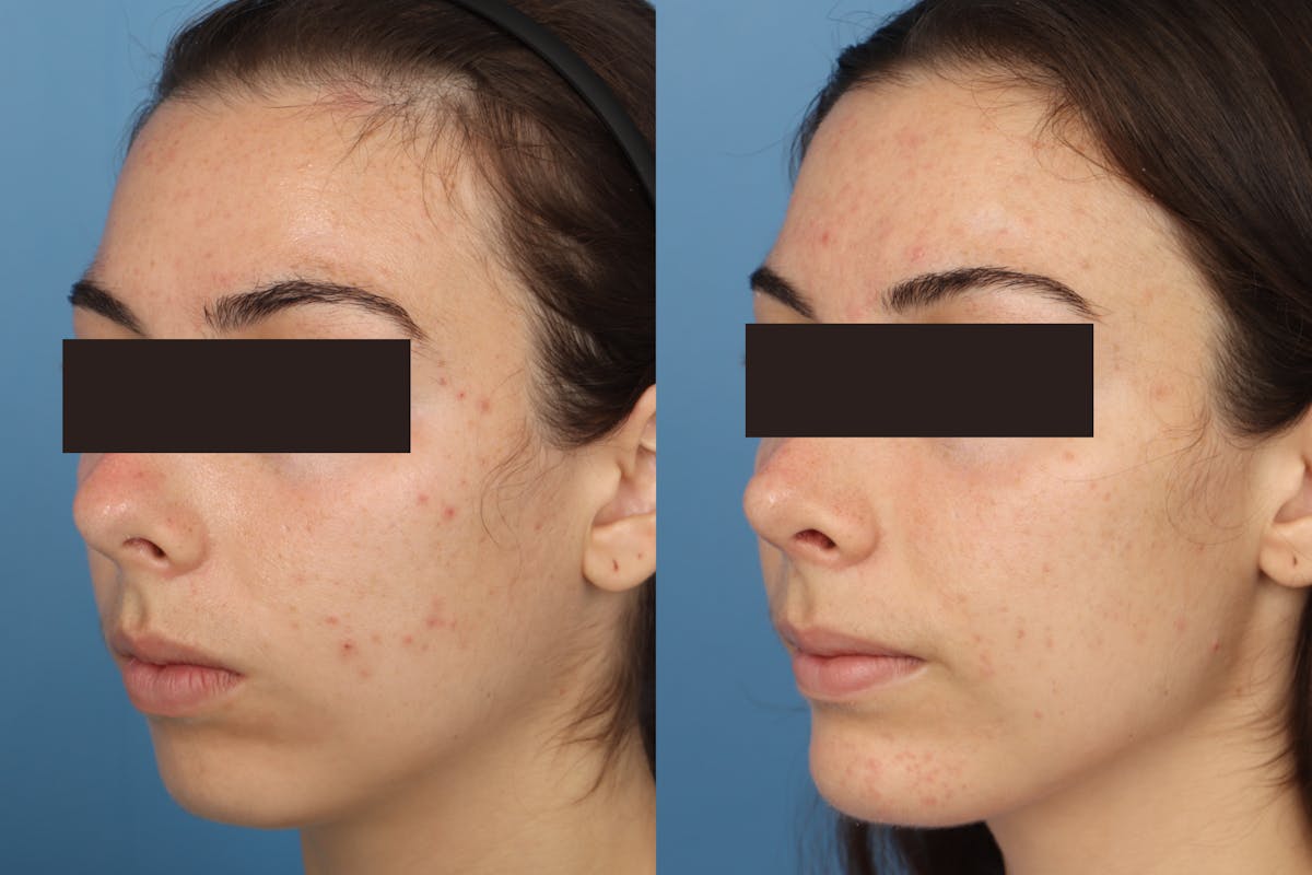 Chin Implant Before & After Gallery - Patient 979992 - Image 1