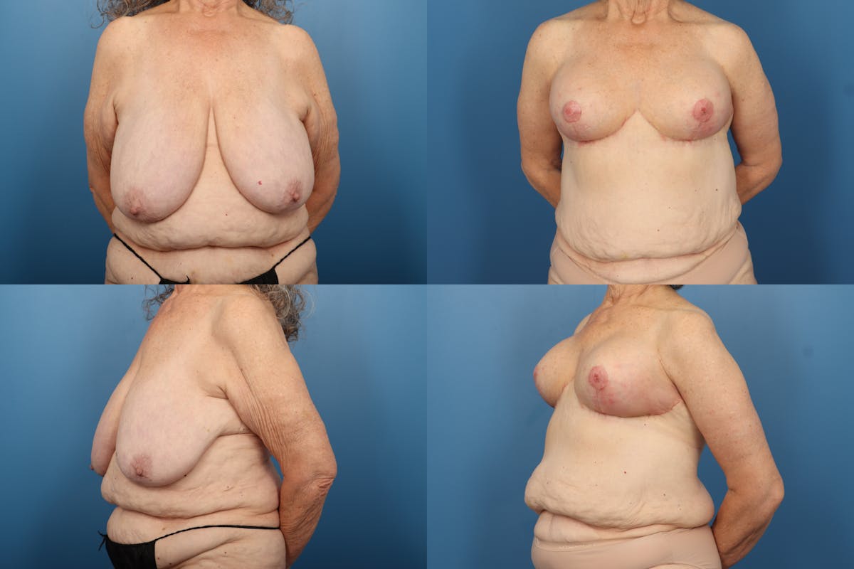 Reductive Augmentation of the Breast Before & After Gallery - Patient 371026 - Image 1