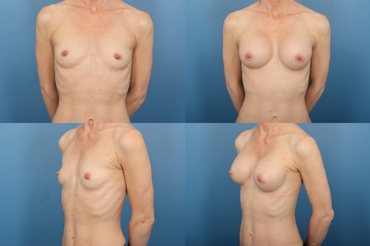 Medium C Round Breast Before & After Gallery - Patient 155702 - Image 1