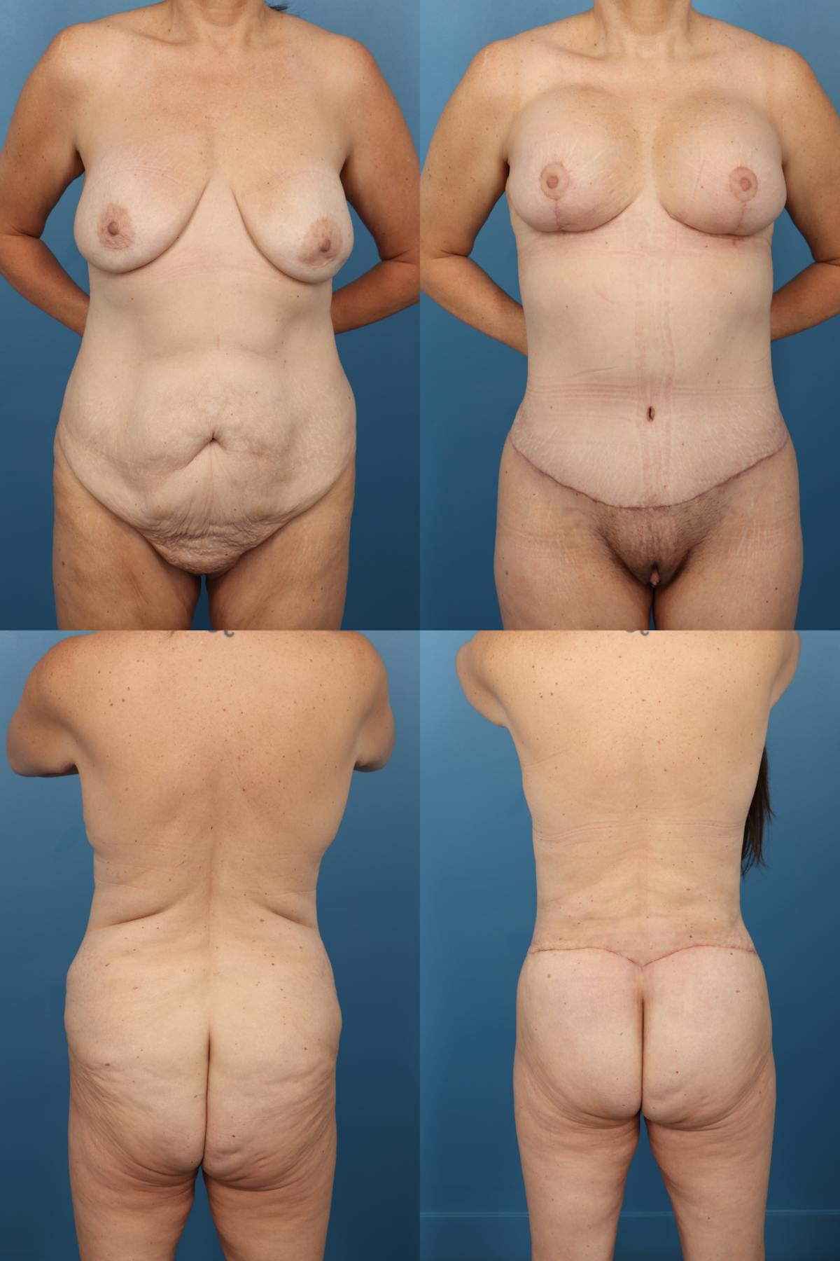 Mommy Makeover Before & After Gallery - Patient 982822 - Image 1