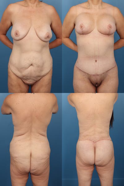 Tummy Tuck Before & After Gallery - Patient 373779 - Image 1