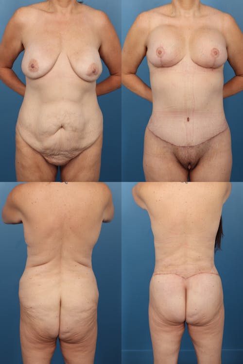 Patient 1 Before - Body Lift / Thigh Lift
