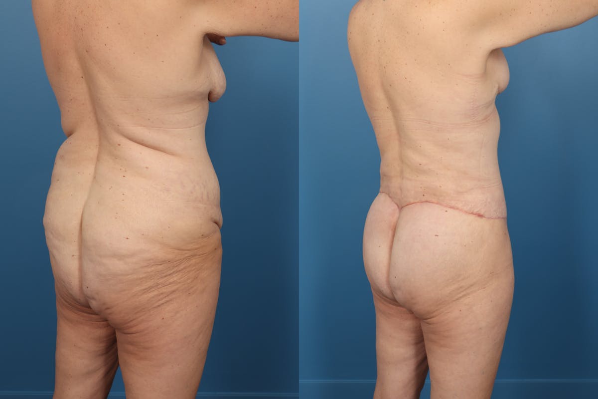 Brazilian Butt Lift Before & After Gallery - Patient 266999 - Image 1