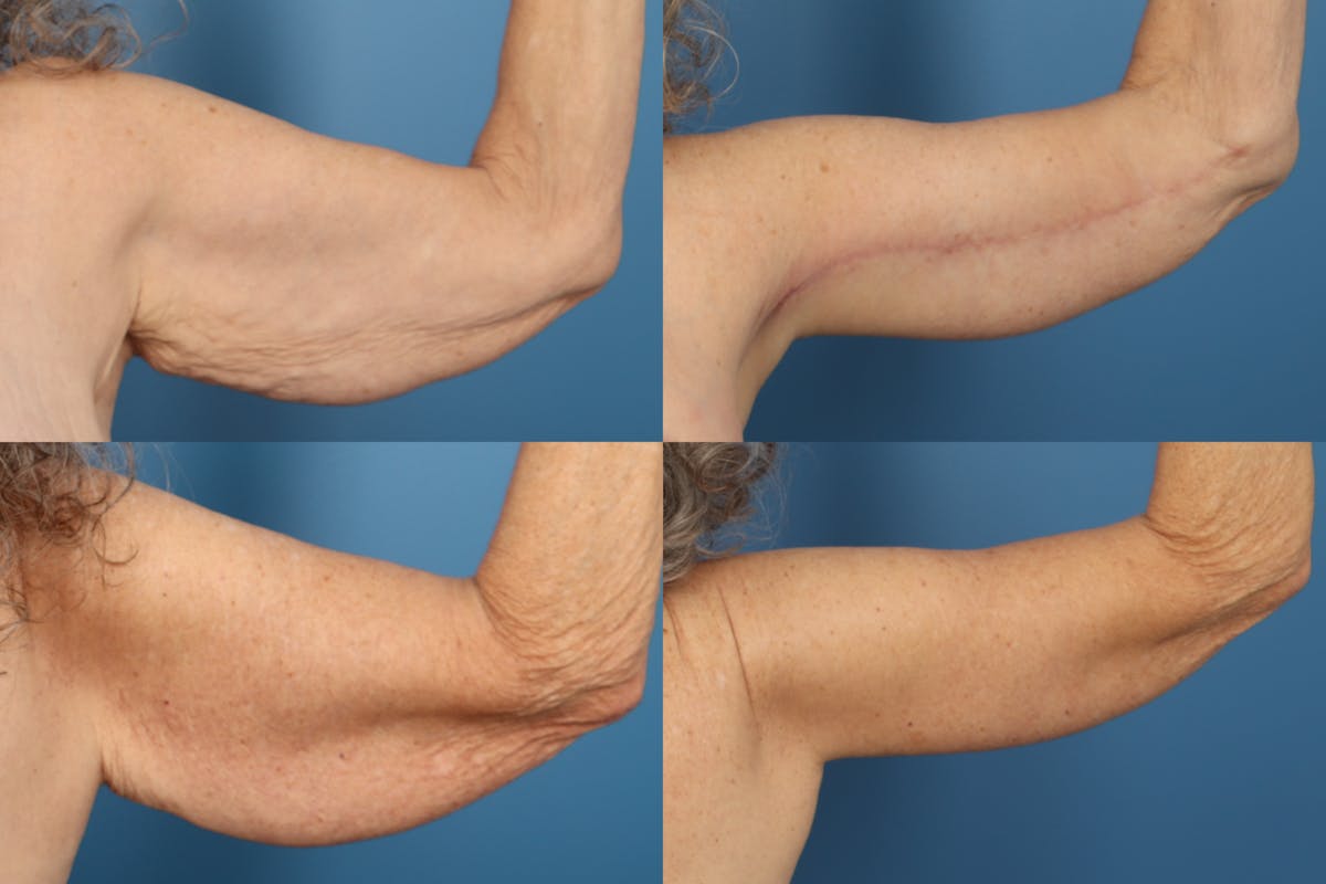 Arm Lift Before & After Gallery - Patient 334088 - Image 1