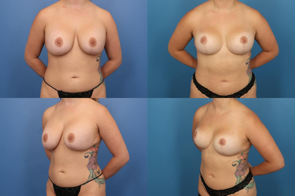 Reductive Augmentation of the Breast Before & After Gallery - Patient 603792 - Image 1