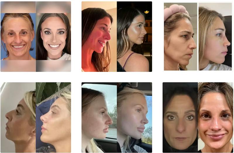 Rhinoplasty Before & Afters
