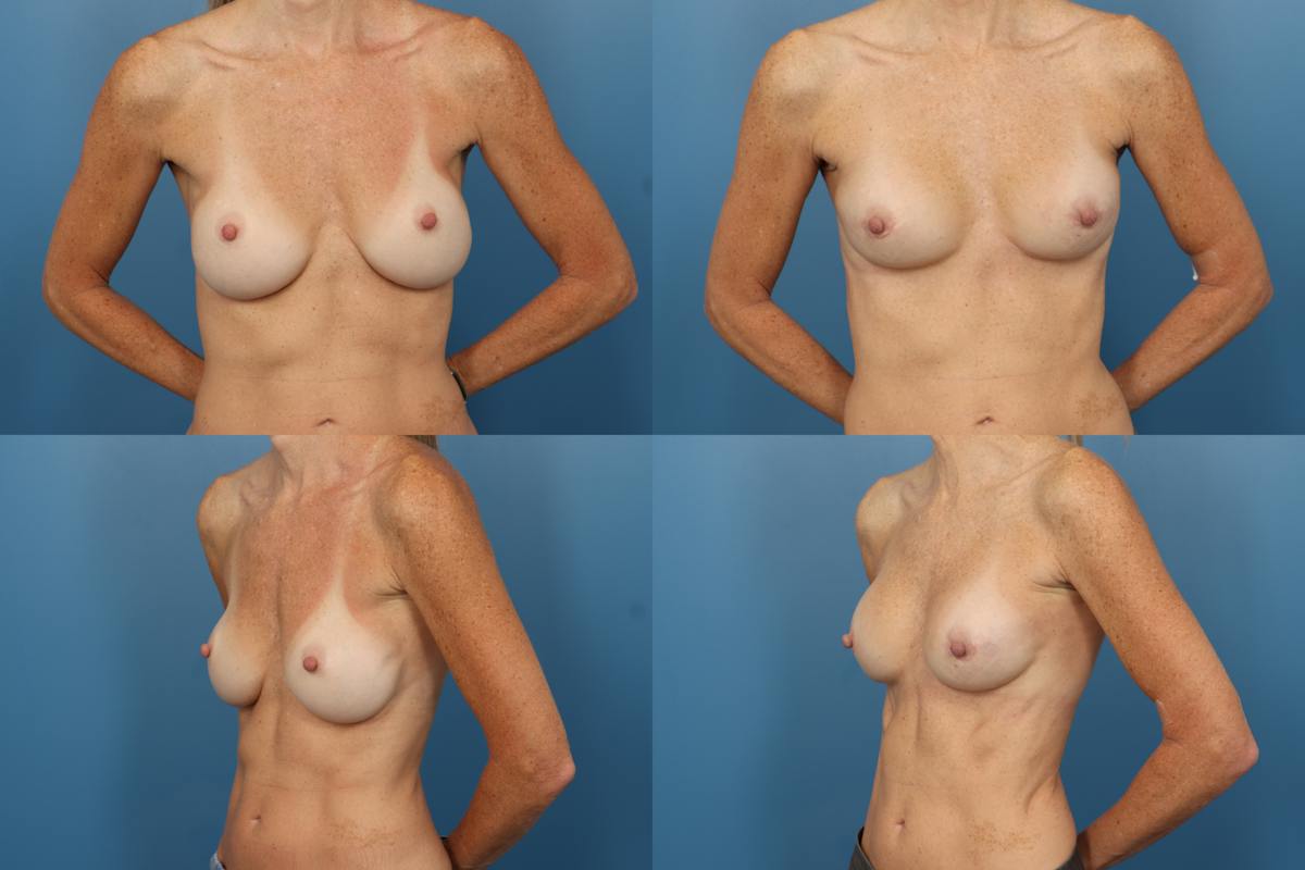 Miscellaneous Before & After Gallery - Patient 525604 - Image 1