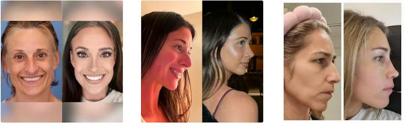 Rhinoplasty Before & Afters