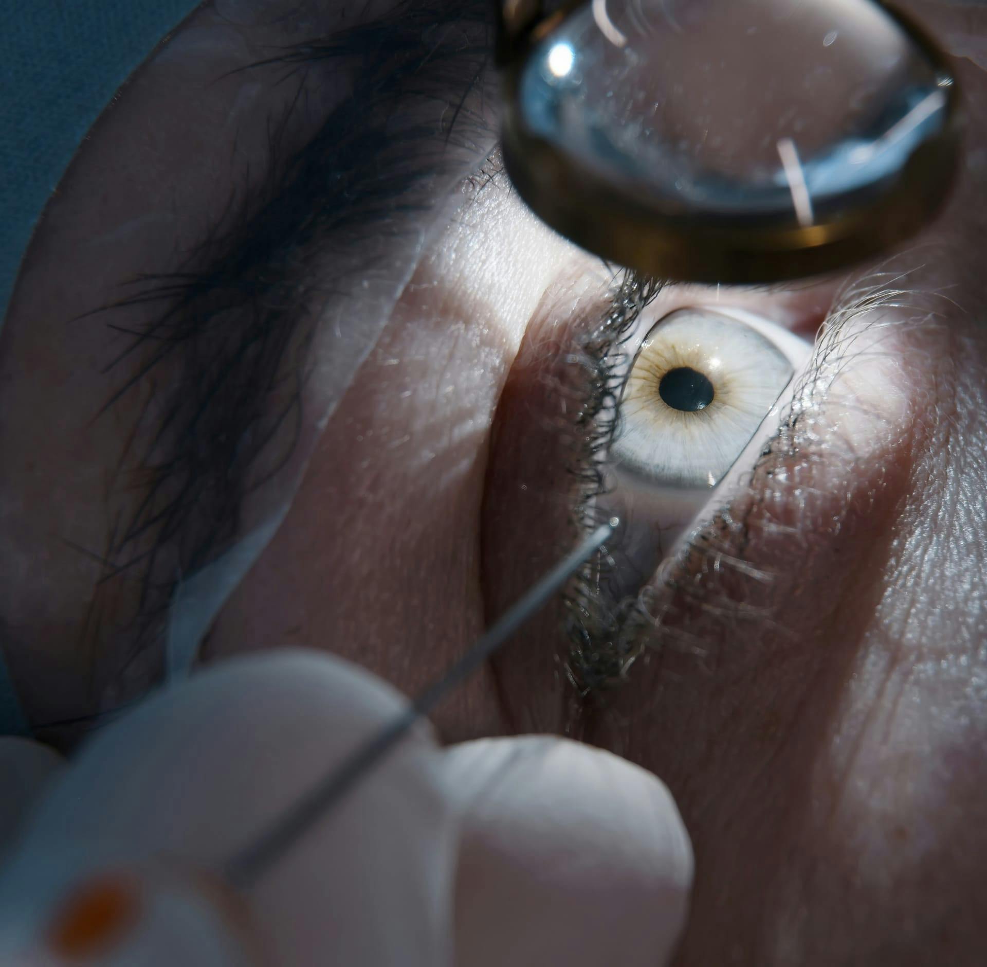 Close up of an eye during procedure