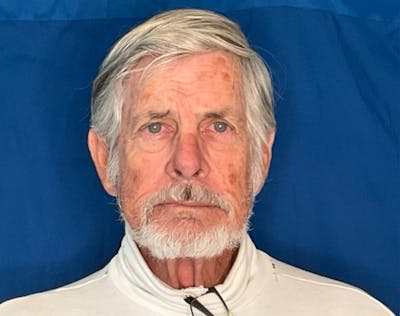 Upper Blepharolplasty Before & After Gallery - Patient 194450 - Image 2