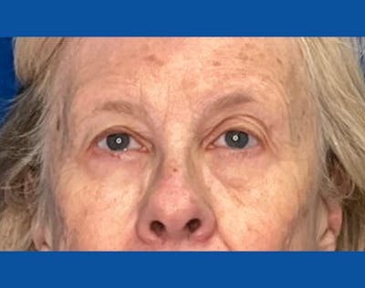 Upper Blepharolplasty Before & After Gallery - Patient 421921 - Image 1