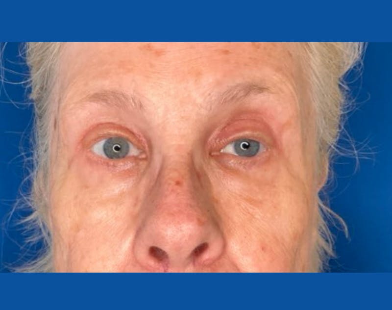 Upper Blepharolplasty Before & After Gallery - Patient 421921 - Image 2