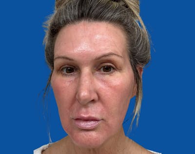 Upper Blepharolplasty Before & After Gallery - Patient 243596 - Image 2