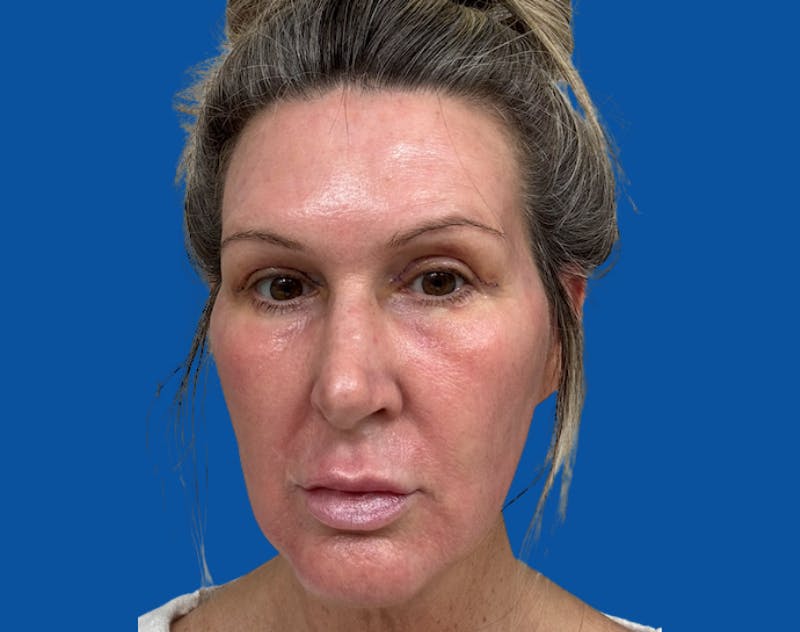 Upper Blepharolplasty Before & After Gallery - Patient 243596 - Image 2