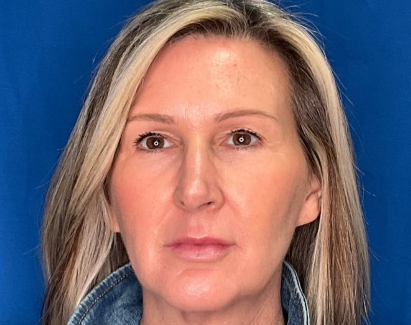 Upper Blepharolplasty Before & After Gallery - Patient 243596 - Image 1