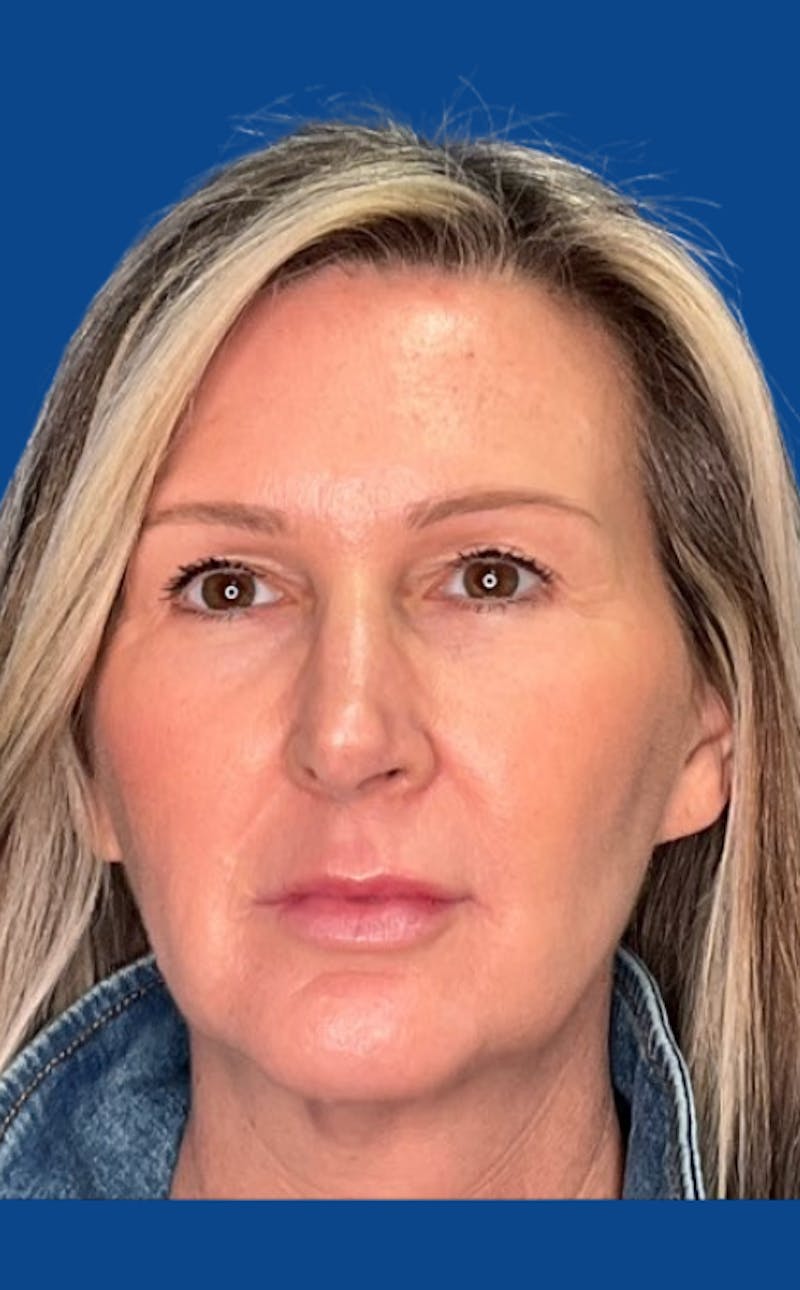 CO2 Laser Before & After Gallery - Patient 250973 - Image 1