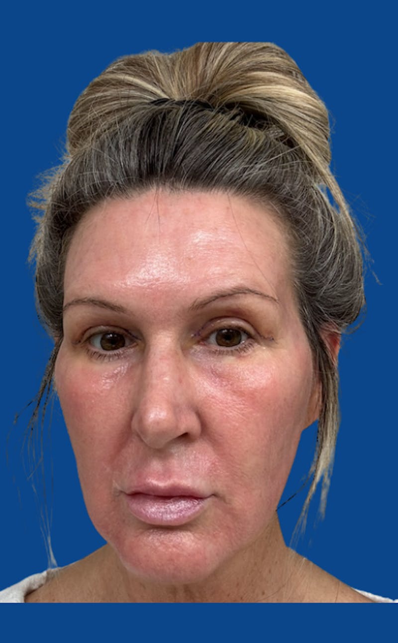 CO2 Laser Before & After Gallery - Patient 250973 - Image 2