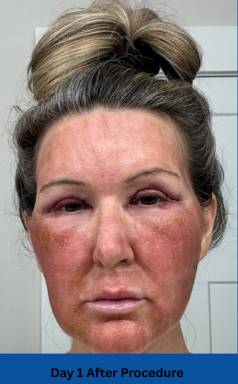 CO2 Laser Before & After Gallery - Patient 250973 - Image 3