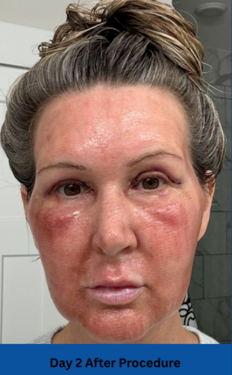 CO2 Laser Before & After Gallery - Patient 250973 - Image 4