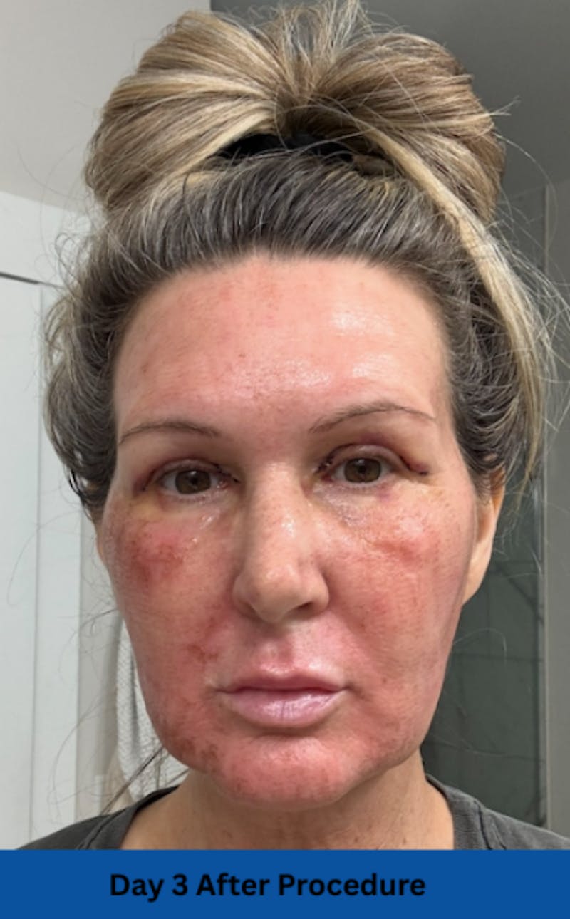 CO2 Laser Before & After Gallery - Patient 250973 - Image 5