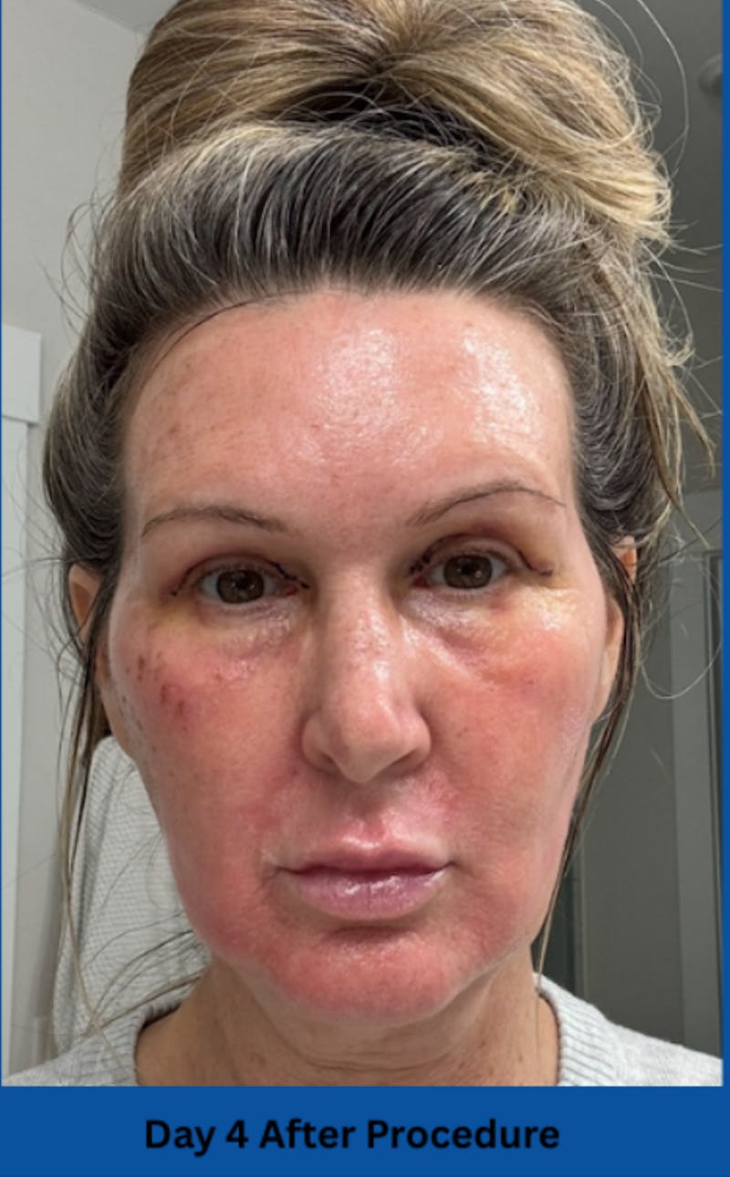 CO2 Laser Before & After Gallery - Patient 250973 - Image 6