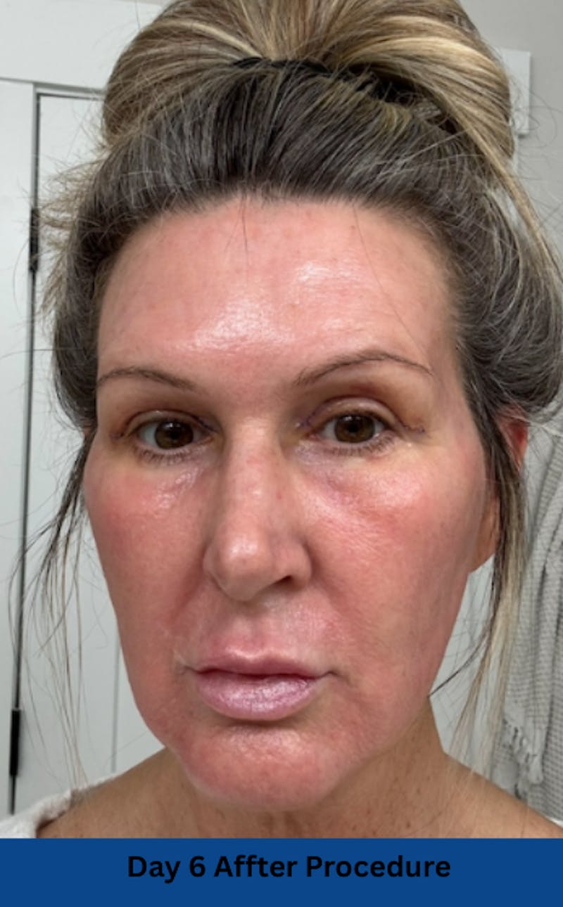 CO2 Laser Before & After Gallery - Patient 250973 - Image 8